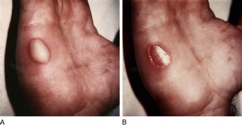 cutaneous abscess  pustule anesthesia key