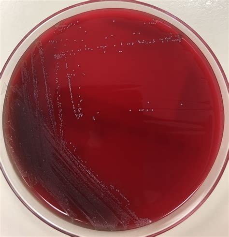 Microbiology Case Study: 68 Year Old Female with Streptococcus anginosus in a Tracheostomy Wound ...