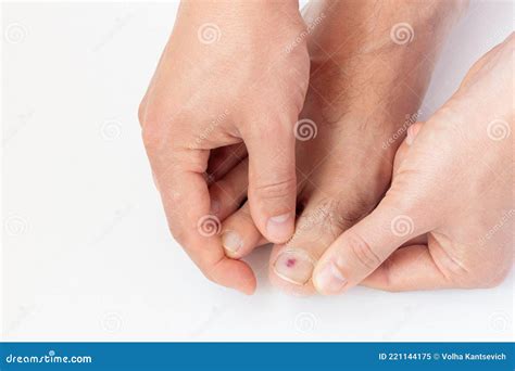 A Man Shows A Purple Bruise Under Toe Nail On White Background Close-up ...