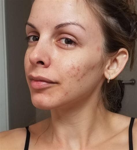 What causes an eyelid twitch – Artofit