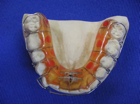 Studium Techniki Dentystycznej KM Dental - Wrocław | Aparaty czynne ...