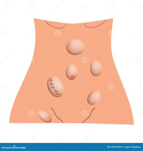 Tipi Di Ernie Epigastrico, Laterale, Ombelicale, Inguinale, Femorale