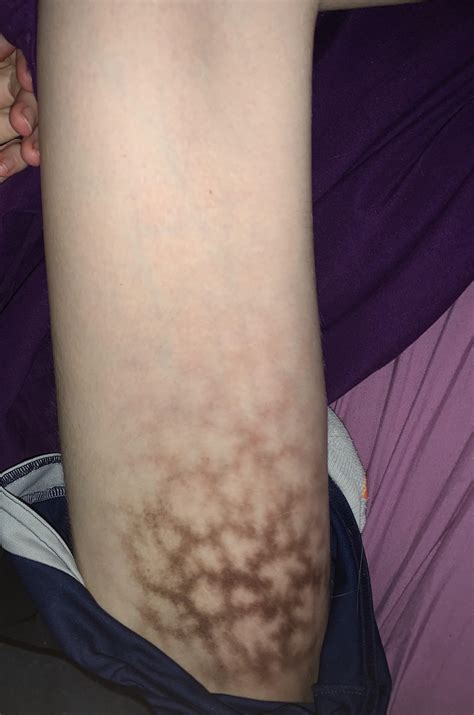 Why Is The Skin On My Thighs Burning at Fred Winfield blog