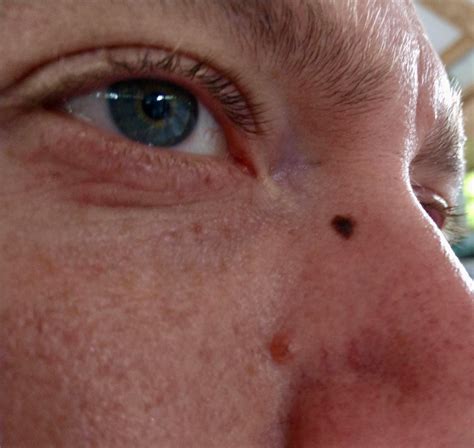 Early Malignant Melanoma In Situ