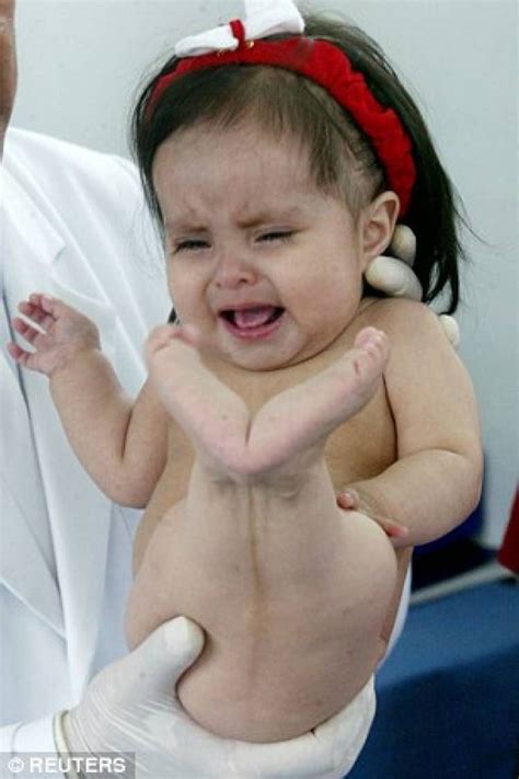 Pin de Obatalayobba em Shiloh Pepin "mermaid syndrome"