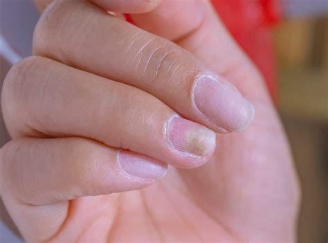 Fotos De Unhas Com Manchas Escuras - Manchas Escuras Na Unha Podem Indicar Câncer? – WPFQTM