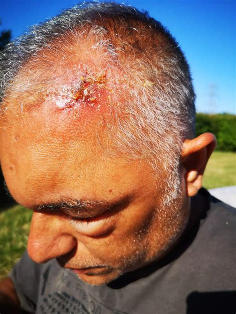 Man bitten on the head by UK's only venomous snake on camping trip