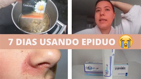 Epiduo Gel Antes E Depois - 7 DIAS USANDO EPIDUO GEL * doeu muito * - YouTube