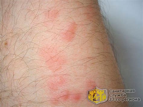 Постельные клопы укусы как избавиться от них