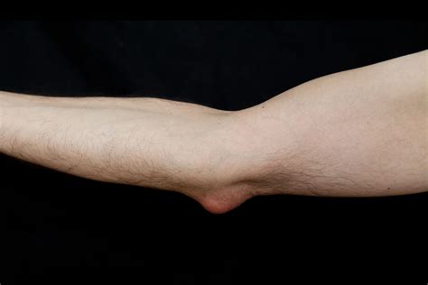 Elbow (Olecranon) Bursitis Symptoms | Arthritis-health