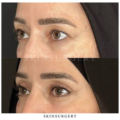 Upper Eyelid Surgery | #1 in Eyelid Surgery | SkinSurgery Clinics