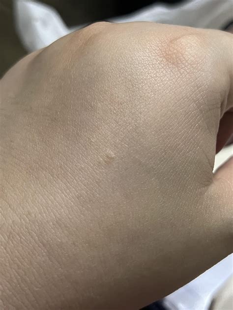 small colorless bumps on hands : r/DermatologyQuestions