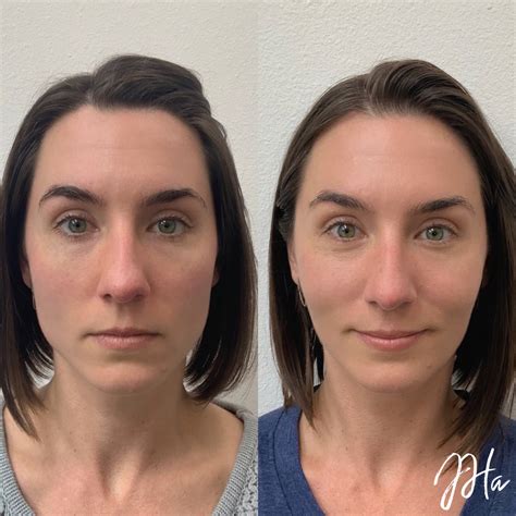 masseter botox skin synthesis
