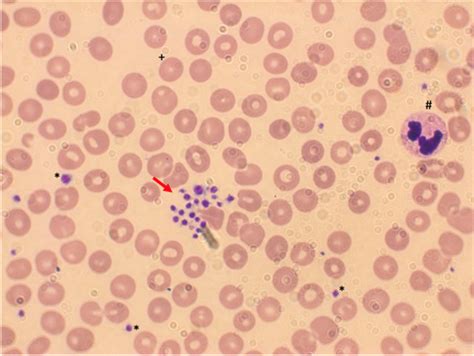 Vaccine-induced pseudothrombocytopenia after Ad26.COV2.S vaccination - PMC