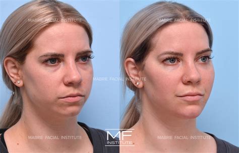 Complete Facial Rejuvenation or Contouring Before and After Pictures