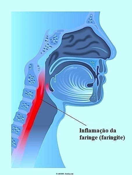 Refluxo E Faringite - Sintomas da faringite e remédios