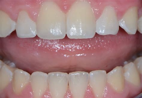 Peg Lateral Position for Optimal Dental Aesthetics - Restorative Nation