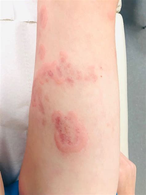 Urticaria multiforme in an adolescent: A rare benign rash not to be