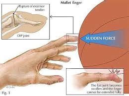 Finger injuries – Diversified Integrated Sports Clinic | Abu Dhabi