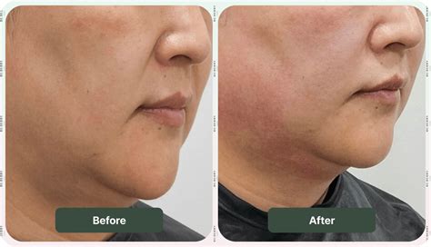 sofwave     visible results