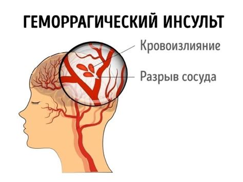 Геморрагический инсульт - причины, развитие, классификация