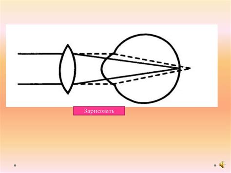 Клиническая рефракция глаза, ее виды и методы её определения, коррекция ...