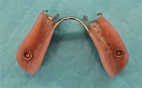 Dental Implant Partial Denture at Cody Wray blog