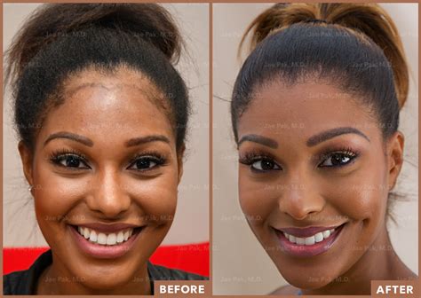 forehead reduction hairline lowering  los angeles