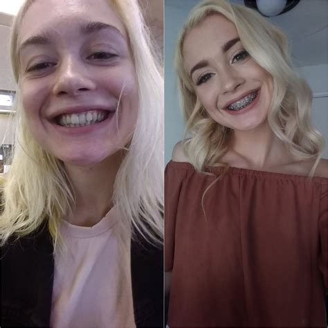[Anastasia Knight, 18] Anyone looking forward to some Brace-face & Teen