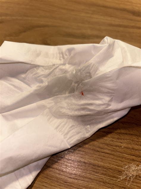 I am spitting a little bit of blood. (With photo) : r/medical_advice