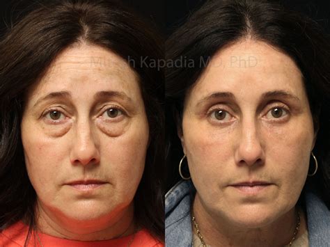Before and six months after lower blepharoplasty surgery and lower