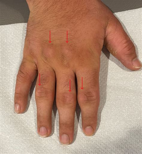 Knuckle pads in adolescents: the role of microtrauma | Anales de Pediatría