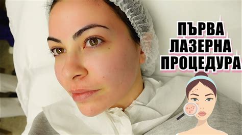 ЛАЗЕР ЗА БЕЛЕЗИ ОТ АКНЕ + как излекувах проблемна кожа 💕 - YouTube