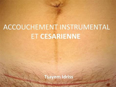 Cesarienne | PPT