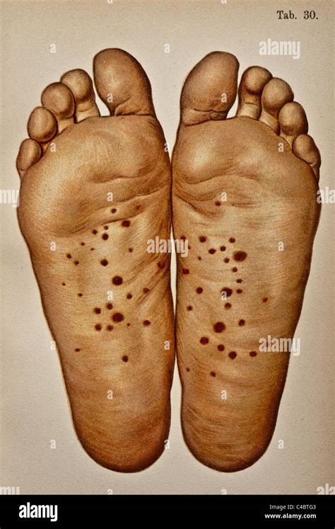 Syphilis rash hi-res stock photography and images - Alamy