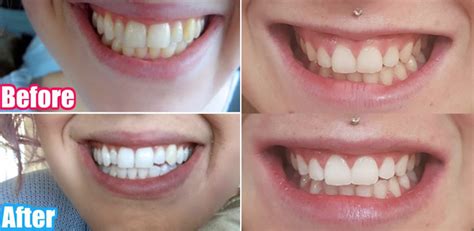 Teeth Treat: Teeth whitening kits that work