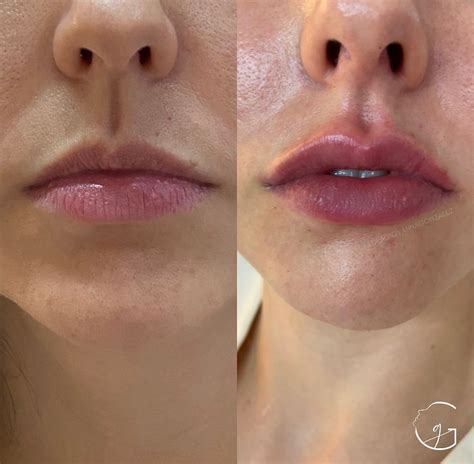 Preenchimento Labial 0 5 Ml Antes E Depois - Preenchimento labial: Antes e depois – Antes da Fama