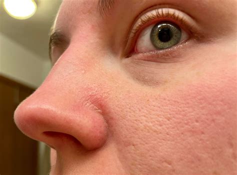 [Skin Concerns] Very Dry Patch : r/SkincareAddiction