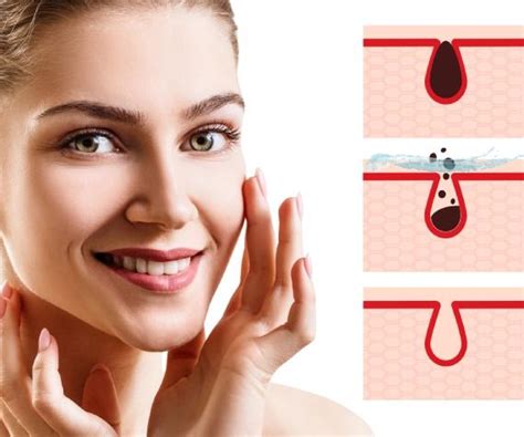 Removing Blackheads Near Me in Chicago, IL | Med Spa Bella Sana