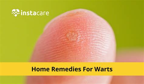 foot warts treatment plantar warts  callus pczxr