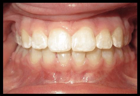 Before and After orthodontic treatment | Pulitzer Orthodontics