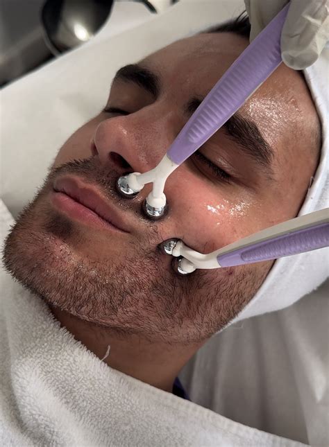 co2 treatments for face 7