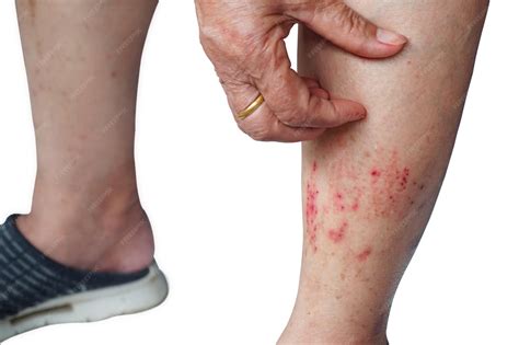 Pele Aspera E Coçando - Coceira com dermatite atópica coceira na pele para reações alérgicas ...