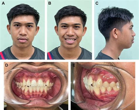 management  bimaxillary protrusion oral  maxillofacial surgery