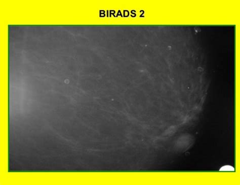 Birads классификация — 24Radiology.ru