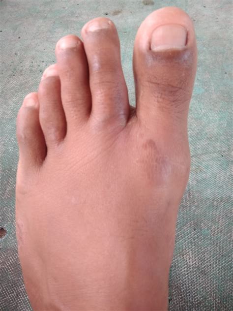 kaki bengkak  titik yg nyeri  ngilu mengeras diselah jari kaki