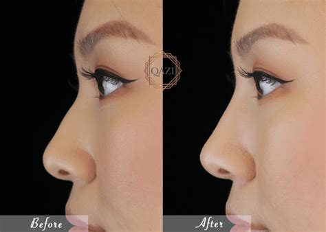 upturned nose rhinoplasty