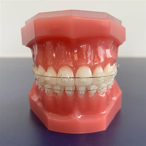 ceramic braces melbourne berwick orthodontic specialists