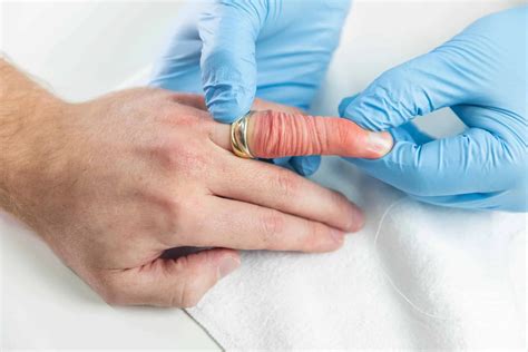how to get a ring off a swollen finger 1