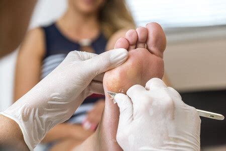 See Your Podiatrist for Callus Removal — Podiatry Group of Annapolis, P.A.